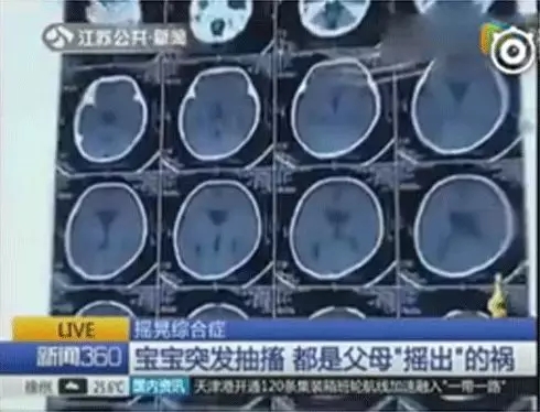 多名婴儿脑出血，家长一个不经意的作为竟然对宝宝中伤这么大1.webp.jpg